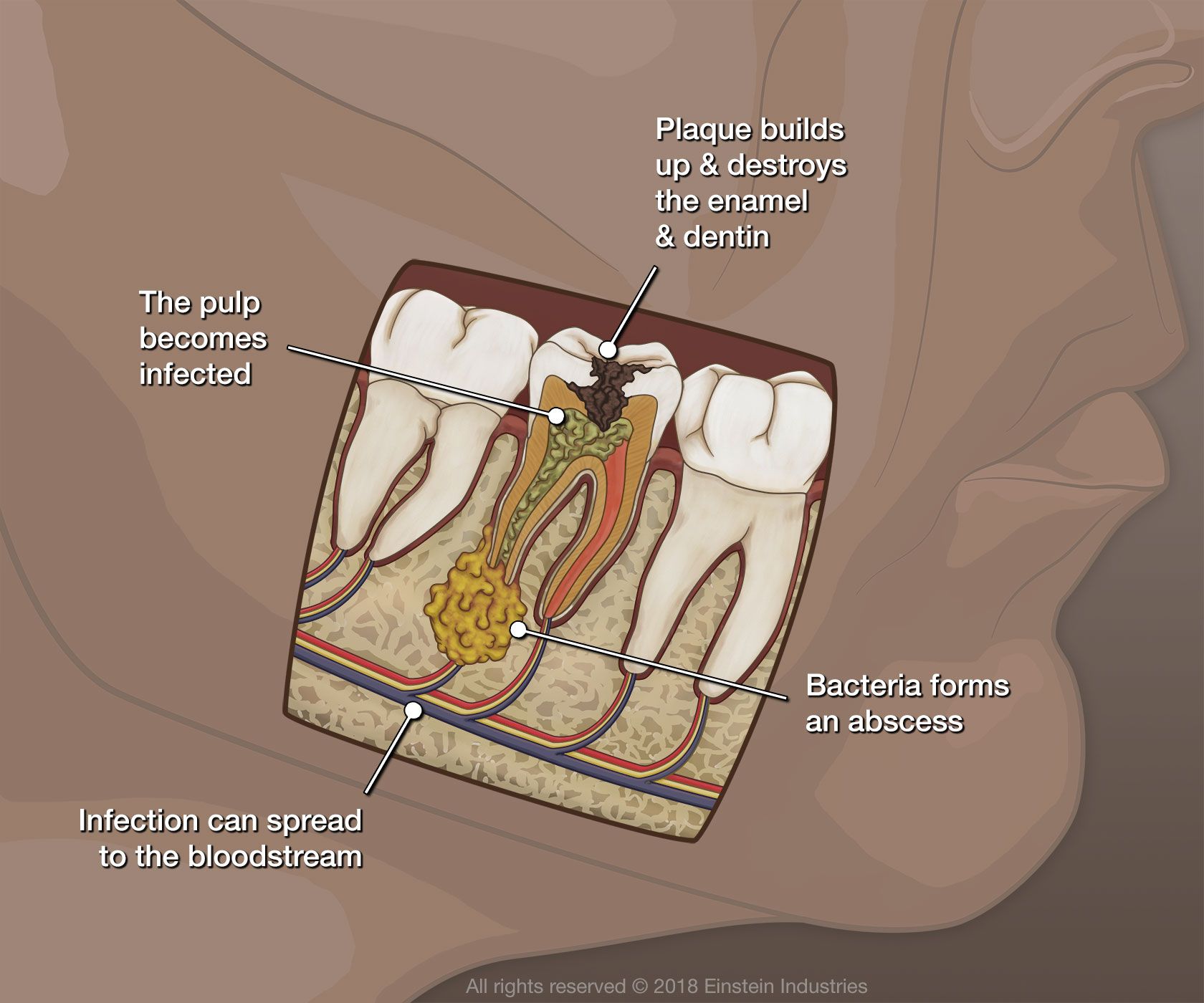 Diagram of infected tooth